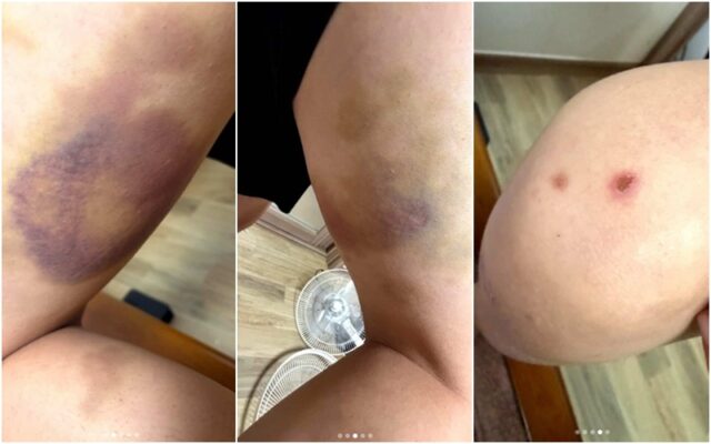 제보 사진에는 피해자의 허벅지와 팔 부위로 보이는 신체 여러 곳에 멍 자국과 담배빵으로 추정되는 상처가 확인된다.(사진=SNS 사진)
